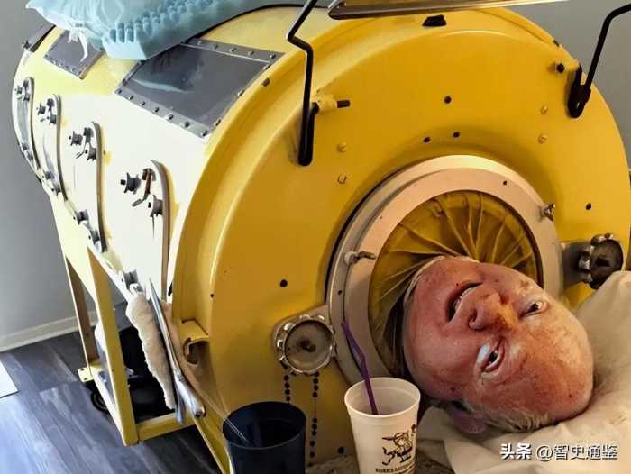断电就会死，在铁桶里躺了71年，他是感动世界的最后一个铁肺人